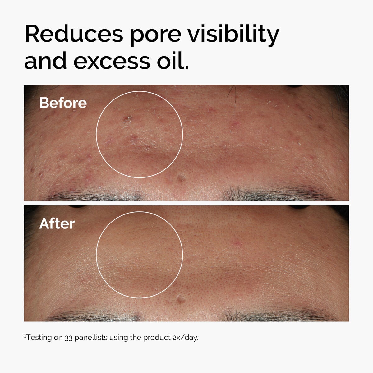 niacinamide-10-zinc-1-g3 ord-niacinamide-zinc-blemish-serum-before-after-pores.jpg