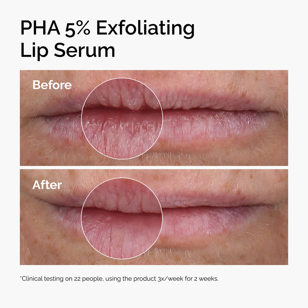 pha-5-exfoliating-lip-serum-x8 ord-pha-5pct-lip-exfoliating-serum-before-after.jpg
