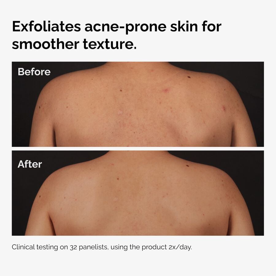 the-body-care-collection-q9 ord-salicylic-acid-body-serum-before-after-graphic-NA.jpg