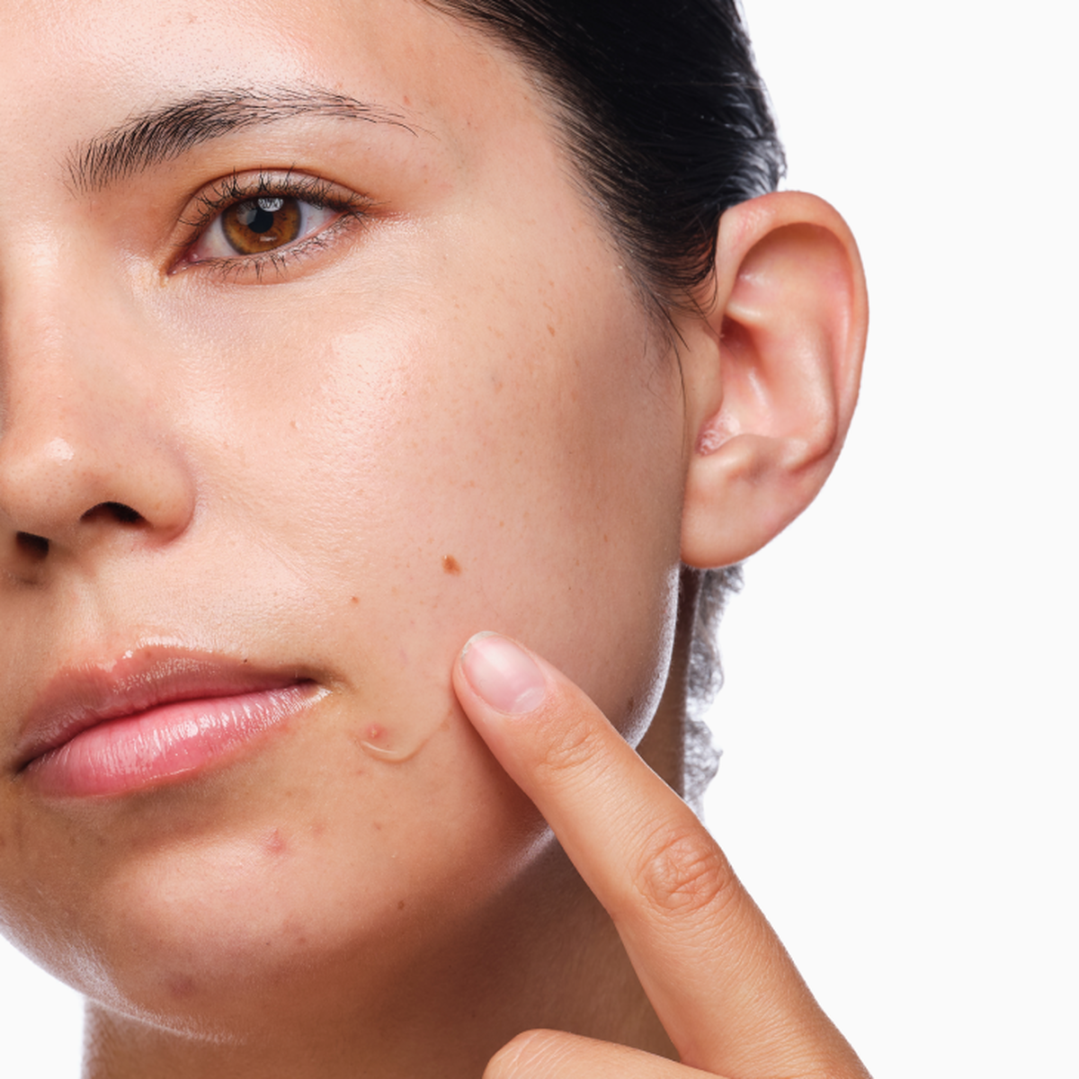 the-acne-set-j7 rdn-the-acne-set-application.png